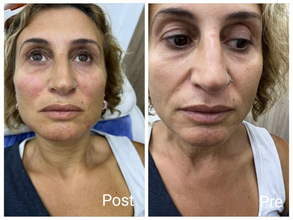 ابر نضارة للوجه قبل وبعد نتيجة فورية